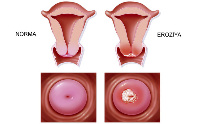 UŞAQLIQ BOYNU EROZİYASI