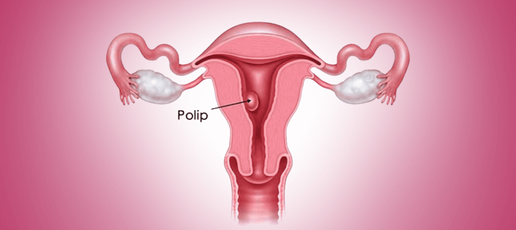 UŞAQLIQ POLİPLƏRİ