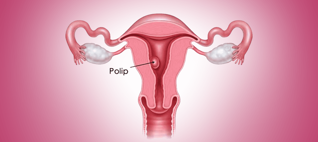 UŞAQLIQ POLİPLƏRİ
