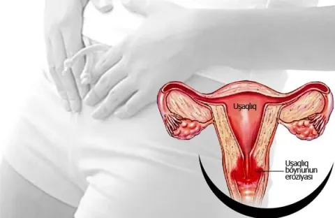 Uşaqlıq boynu eroziyası