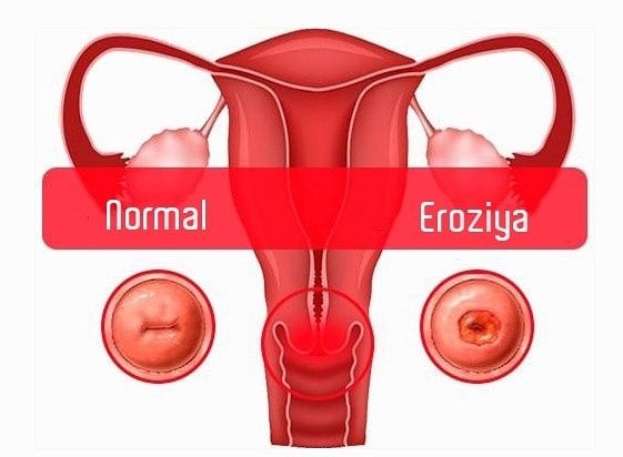 SERVİKAL EROZIYA (UŞAQLIQ BOYNUNUN EROZİYASI)