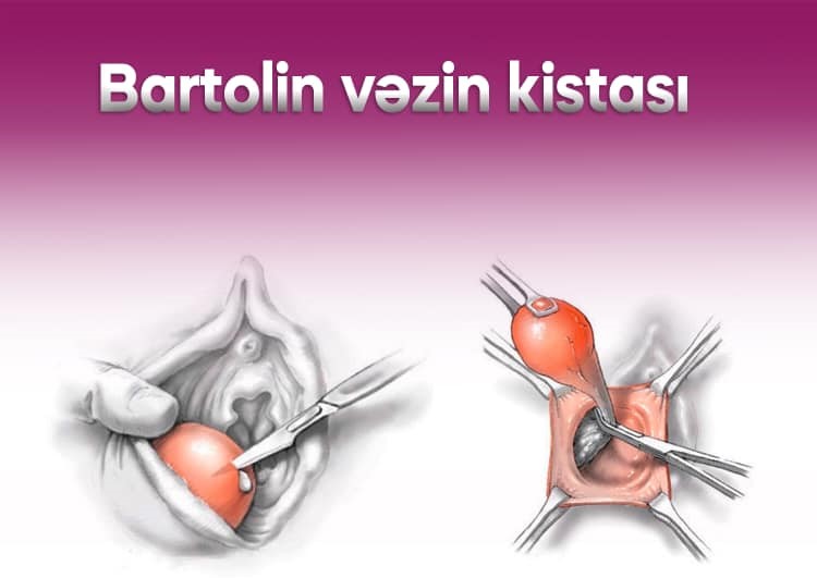 Bartolin vəzinin iltihabı